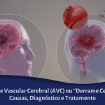 Acidente Vascular Cerebral AVC