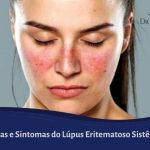 Sintomas do Lupus