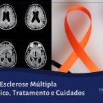 tratamento da esclerose múltipla
