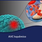 AVC Isquêmico